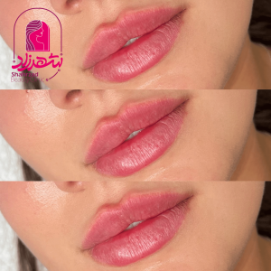 lipfiller13