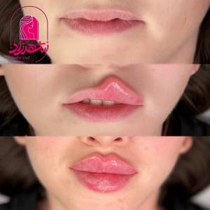 lipfiller14