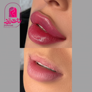 lipfiller15