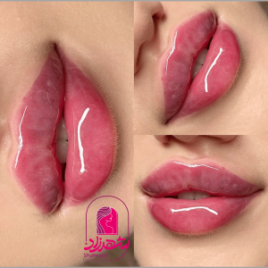 lipfiller16