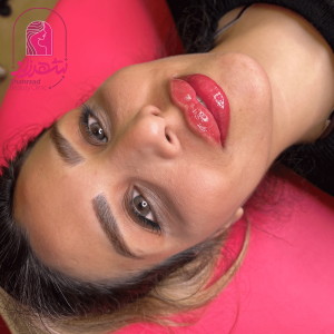 lipfiller20
