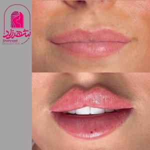 lipfiller4