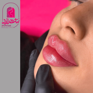 lipfiller7