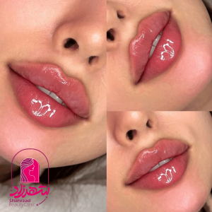 lipfiller8