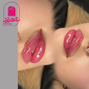 lipfiller9