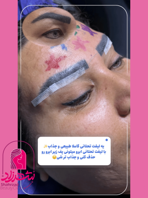 lower-brow-lift1