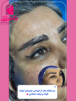 lower-brow-lift10