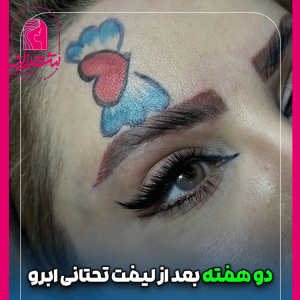 lower-brow-lift11