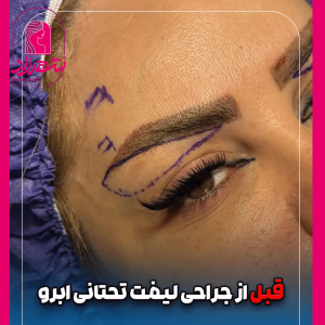 lower-brow-lift12