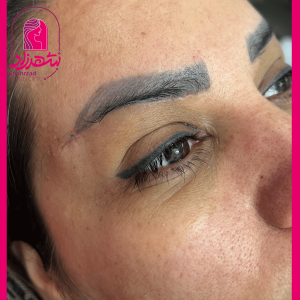lower-brow-lift13