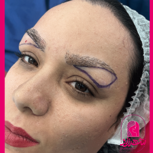 lower-brow-lift14