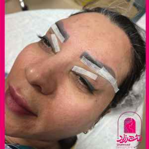 lower-brow-lift15