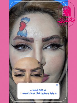 lower-brow-lift2
