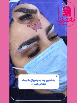 lower-brow-lift3