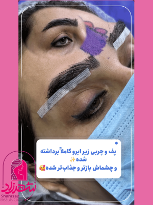 lower-brow-lift4