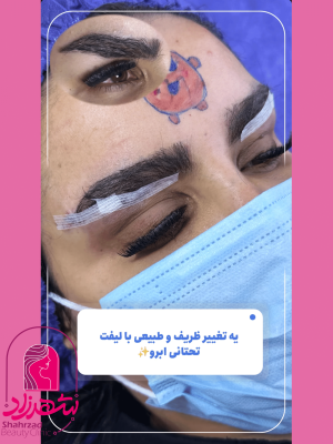 lower-brow-lift5