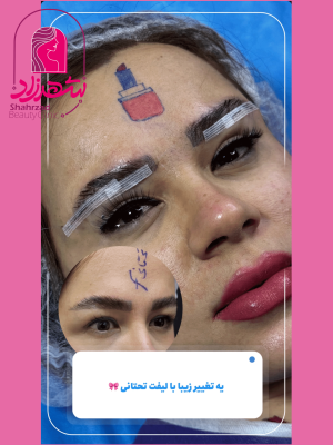 lower-brow-lift6