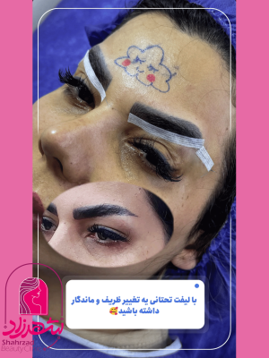 lower-brow-lift7