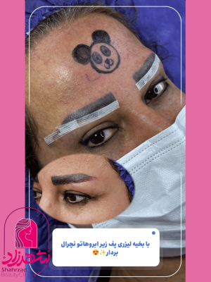 lower-brow-lift8