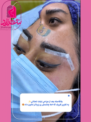 lower-brow-lift9