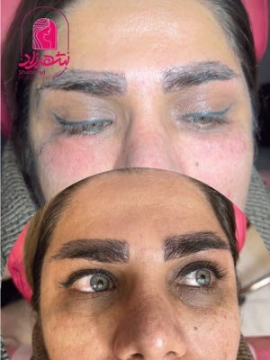 under-eye-filler1 Medium
