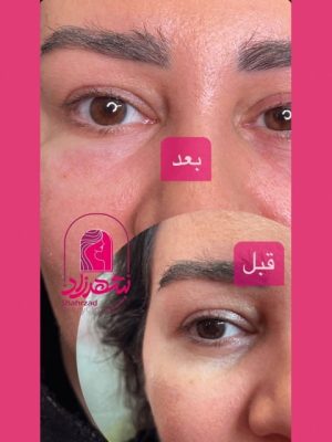 under-eye-filler2 Medium