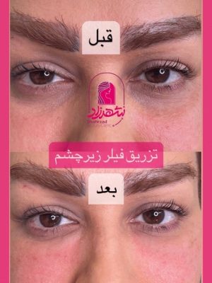 under-eye-filler3 Medium
