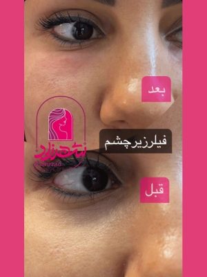 under-eye-filler4 Medium