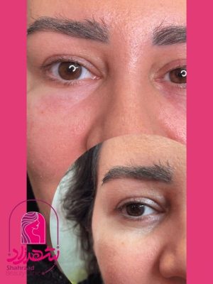 under-eye-filler5 Medium